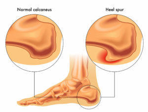 Heel Spurs diagram