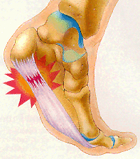 Heel pain is usually intensified after a period of rest