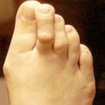bunions and hammer toes