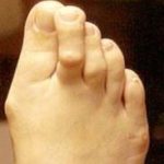 bunions