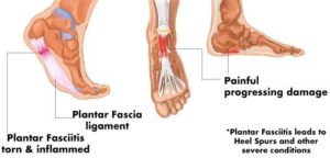 torn plantar fascia