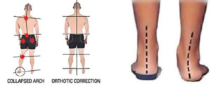 corrective foot orthotics